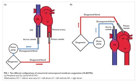 lv venting ecmo|central vs peripheral va ecmo.